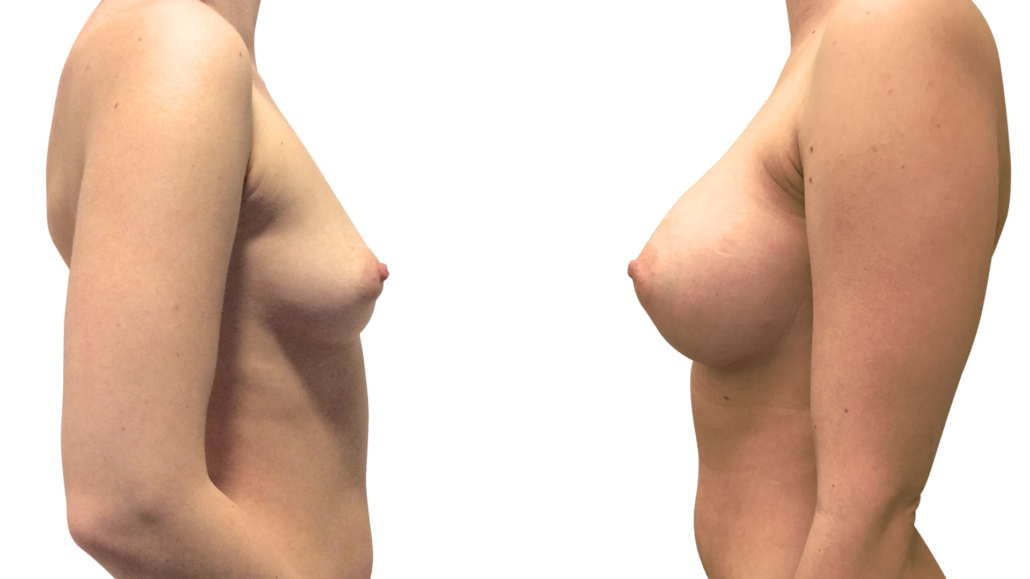 Breast Augmentation Before After Result