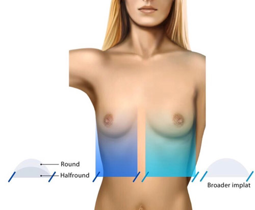 Wichtig ist die natürliche Brustbasis zu respektieren. Es gibt Patientinnen mit schmäleren oder breiteren Brustansätzen.