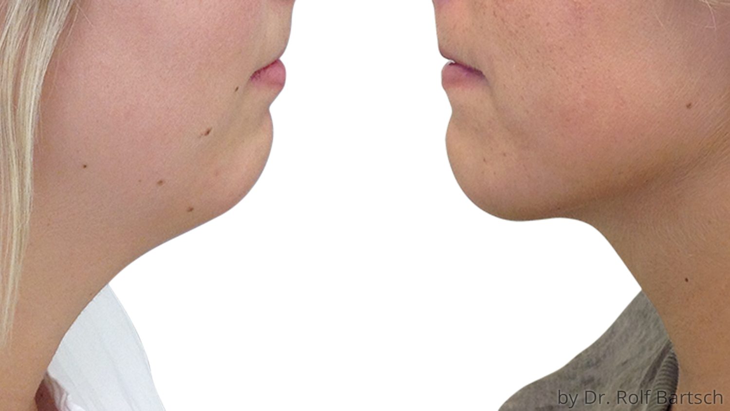 Doppelkinn fettabsaugung Archive TheAesthetics Dr. Rolf Bartsch & Dr. Katrin Bartsch