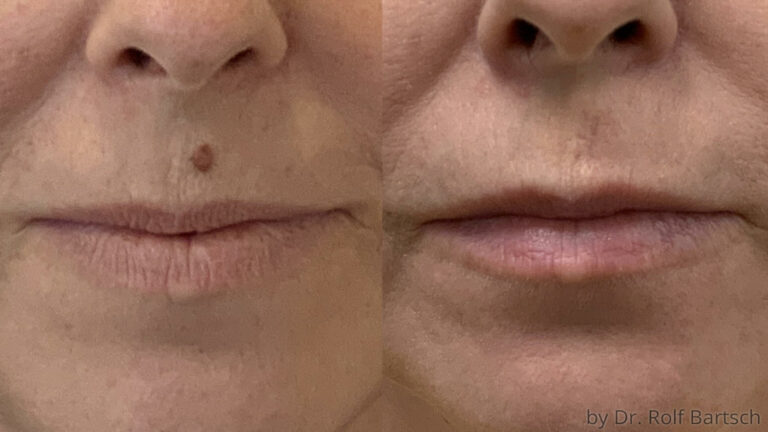 Muttermal Entfernung TheAesthetics Dr Rolf Bartsch Dr Katrin 