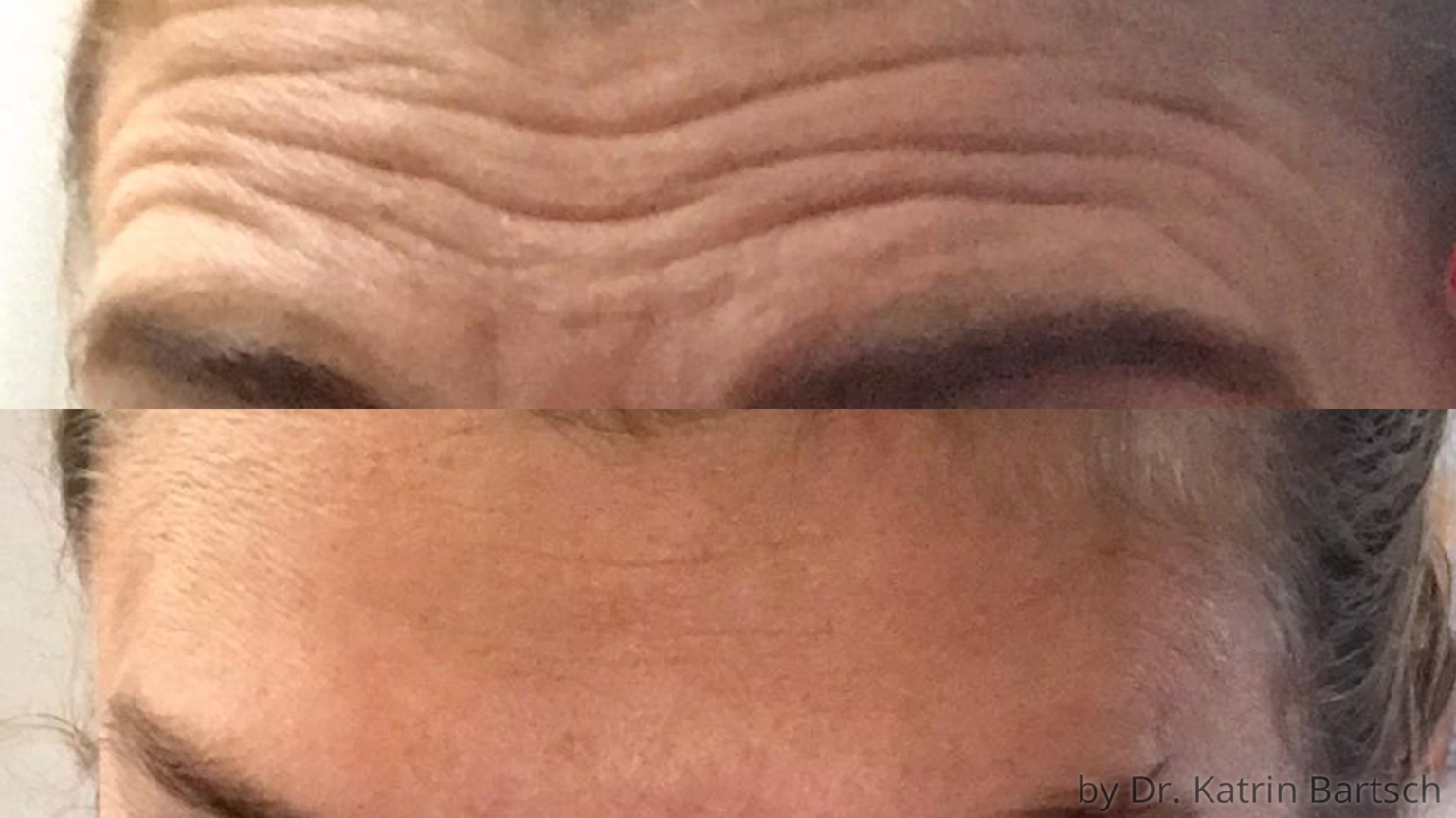 Botox® Botulinumtoxin TheAesthetics Dr. Rolf Bartsch & Dr. Katrin Bartsch Plastische