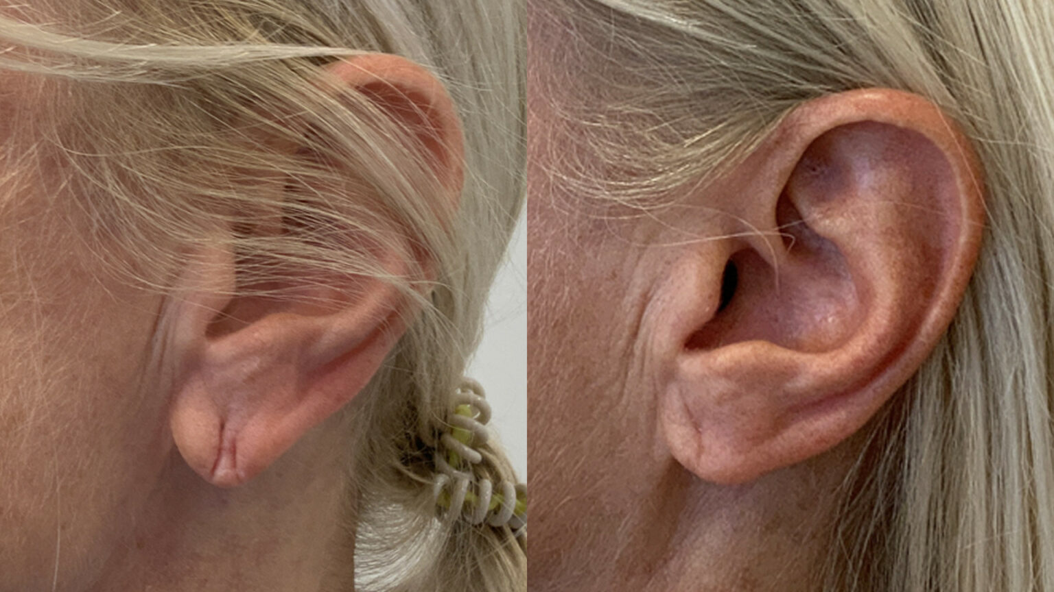 Falte Im Ohrläppchen Durch Ohrring www.theaesthetics.at