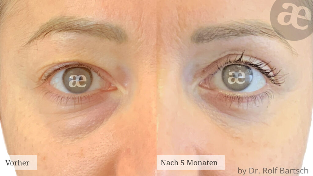 Unterlidstraffung TheAesthetics Dr. Rolf Bartsch & Dr. Katrin Bartsch Plastische Chirurgie