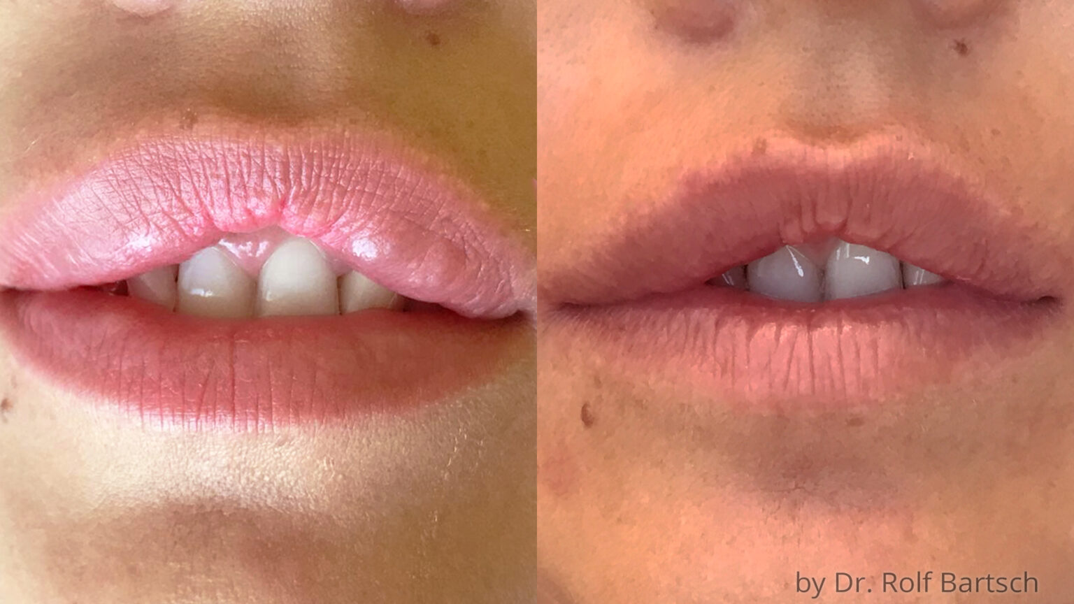 0 55 Ml Hyaluronsäure Lippen Vorher Nachher www.theaesthetics.at