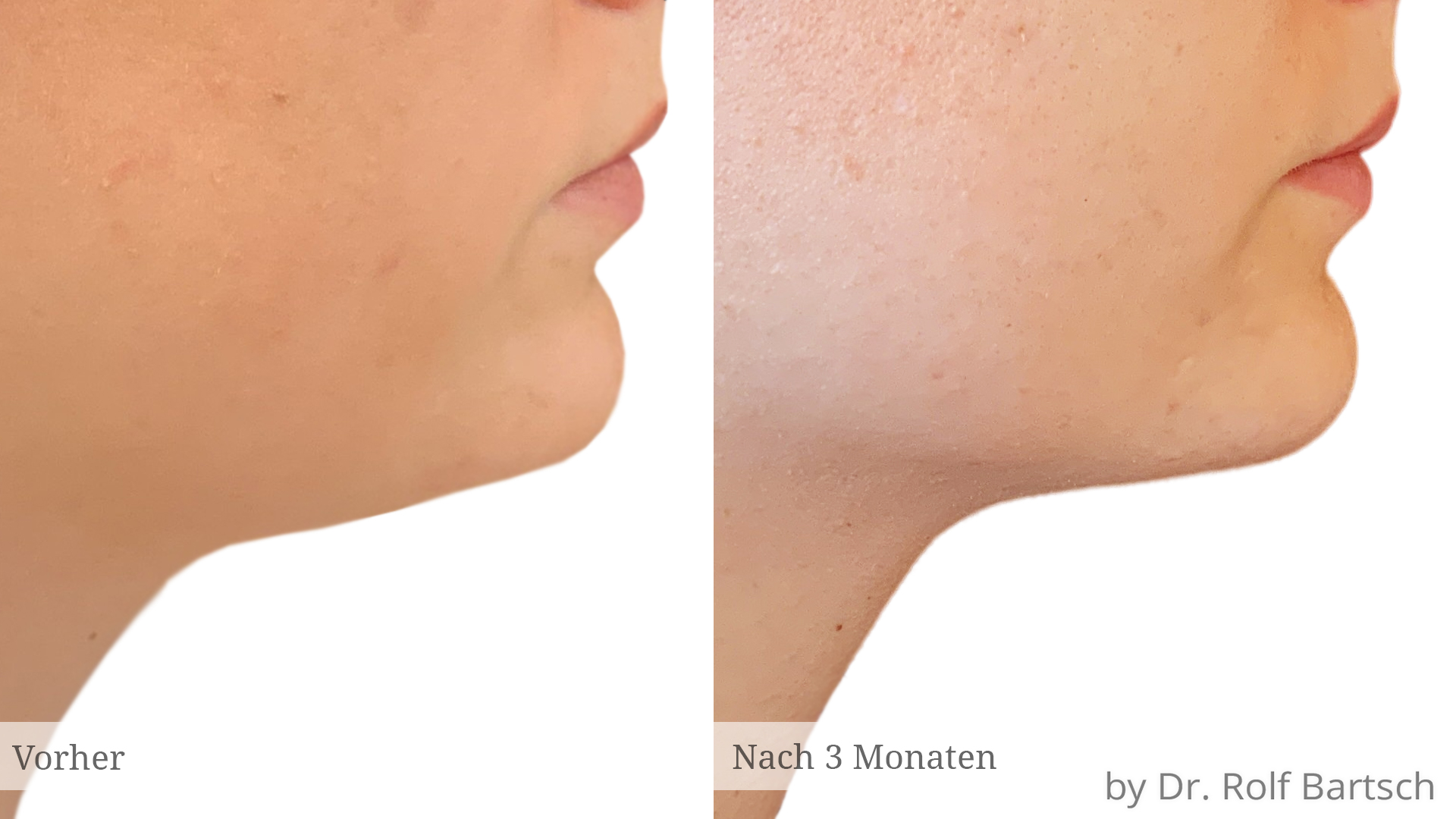 Doppelkinn fettabsaugung Archive TheAesthetics Dr. Rolf Bartsch & Dr. Katrin Bartsch