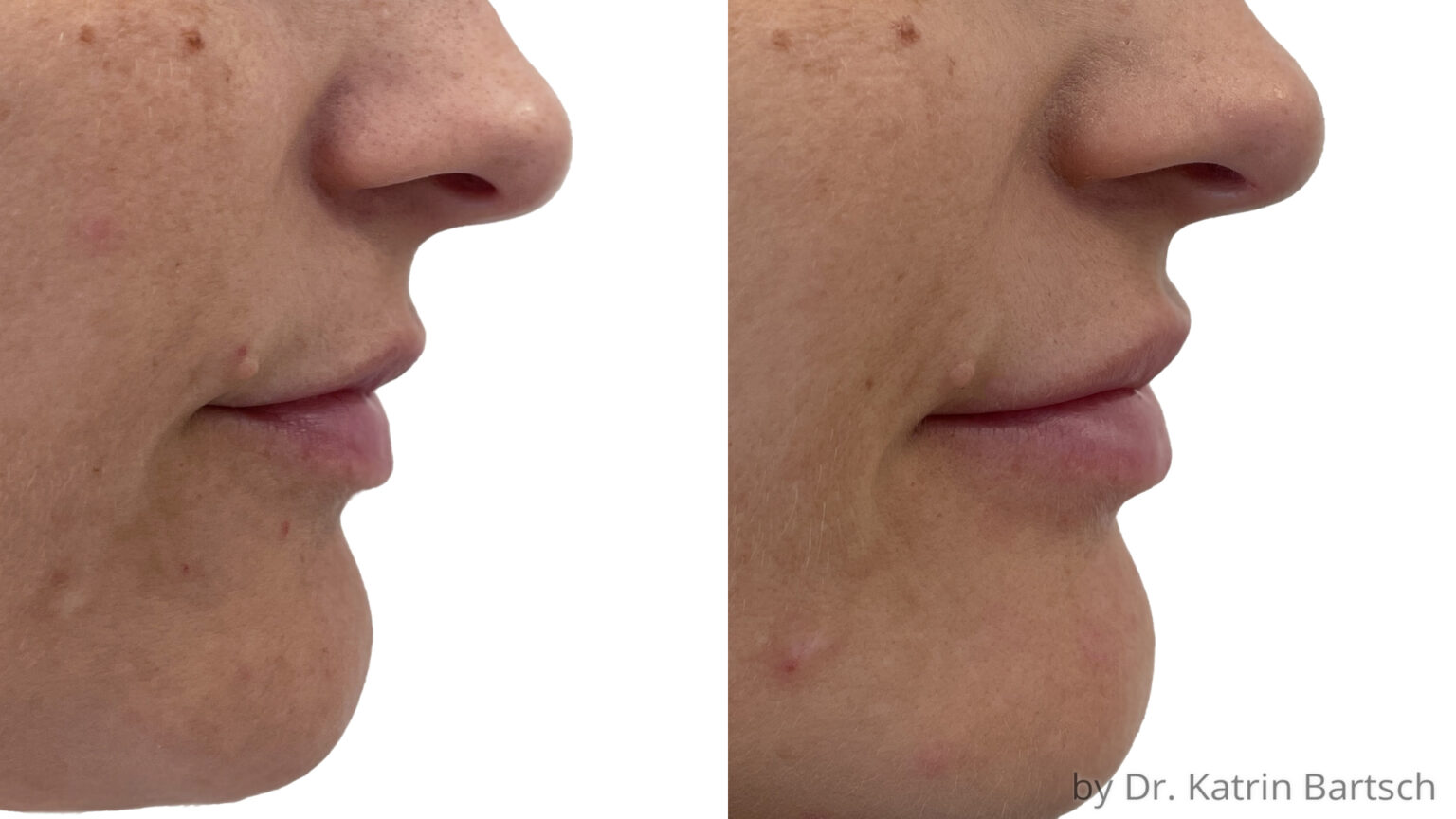 Hyaluronsäure Filler | Lippen Archive - TheAesthetics Dr. Rolf Bartsch