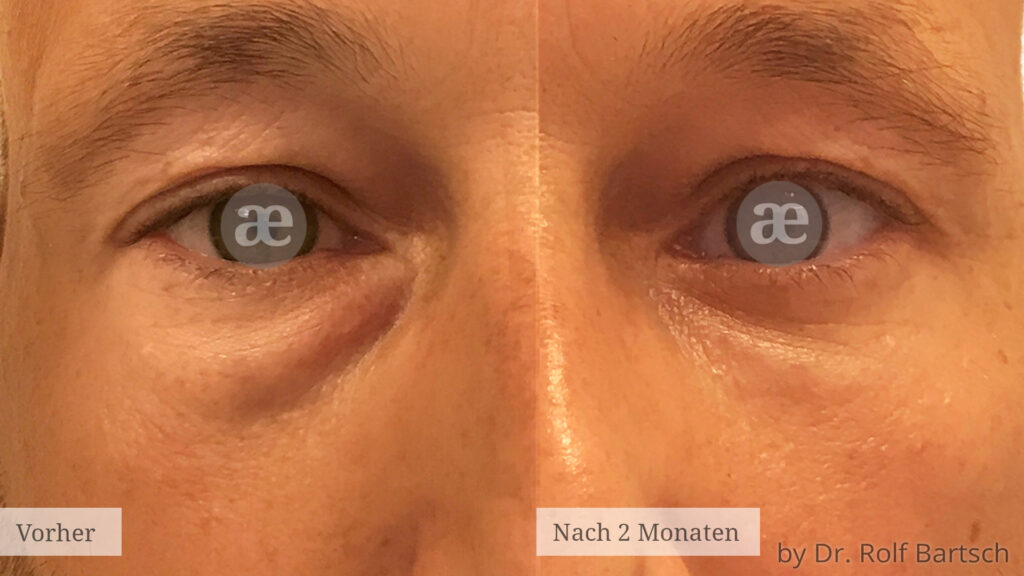 Unterlidstraffung TheAesthetics Dr. Rolf Bartsch & Dr. Katrin Bartsch Plastische Chirurgie