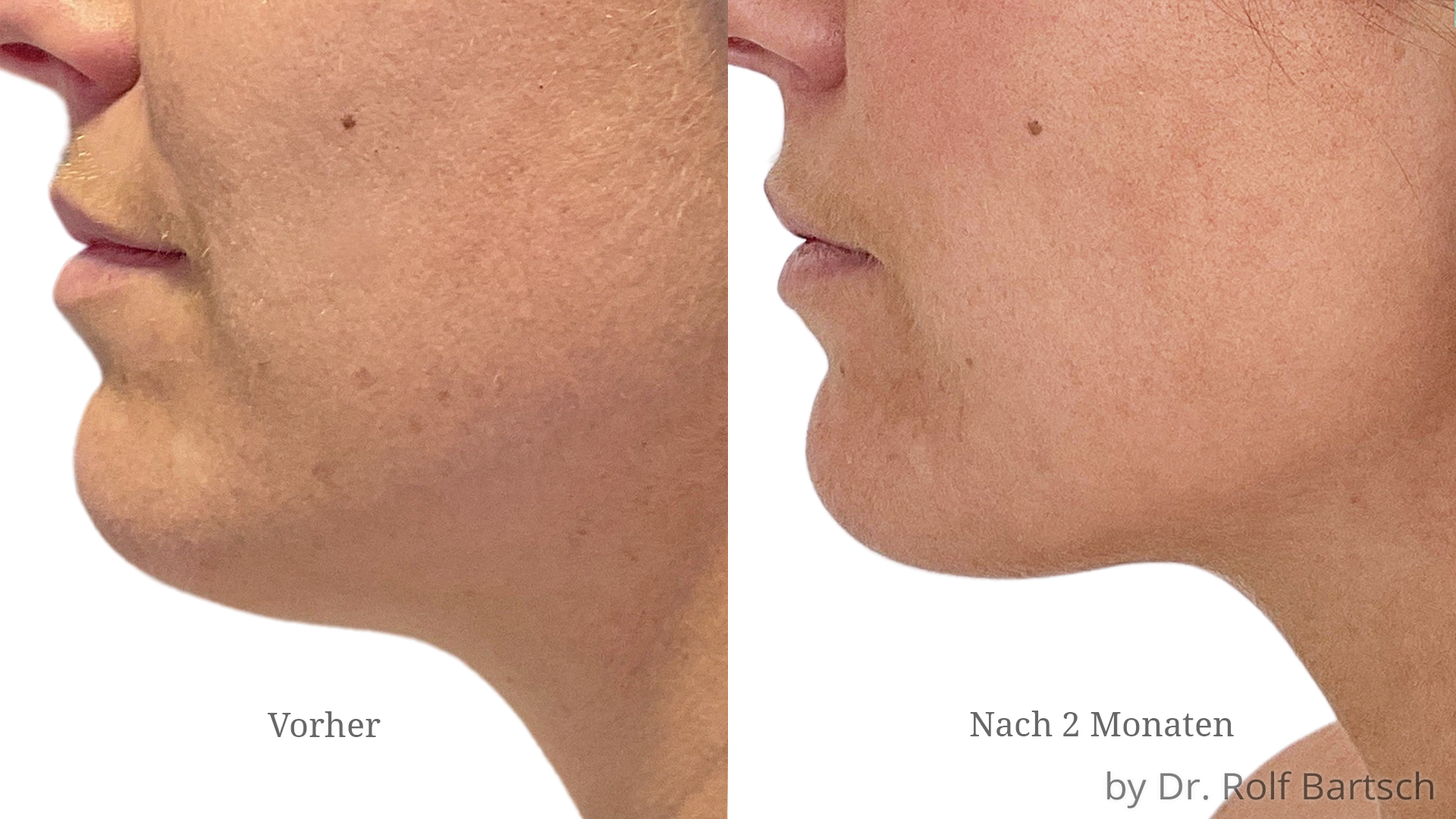 Vorher Nacher Alle Archive TheAesthetics Dr. Rolf Bartsch & Dr. Katrin Bartsch Plastische