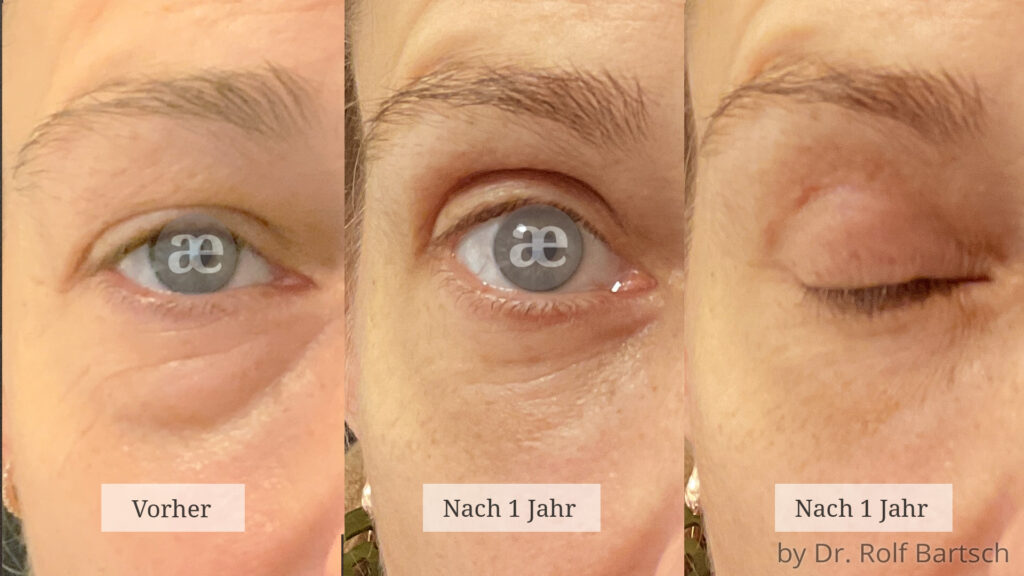 Unterlidstraffung TheAesthetics Dr. Rolf Bartsch & Dr. Katrin Bartsch Plastische Chirurgie