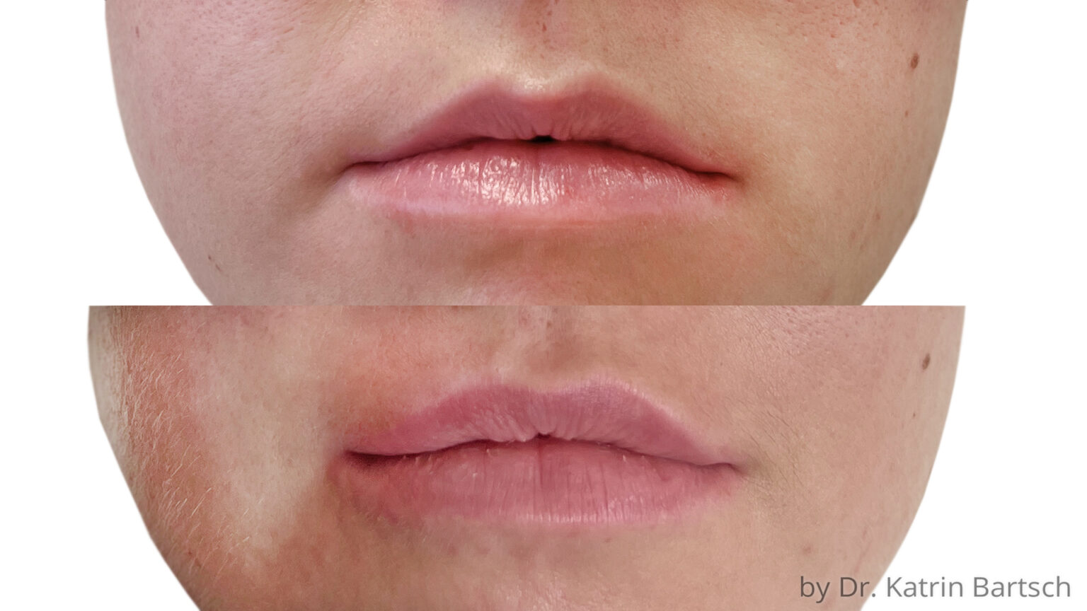 Lippen aufspritzen – LipFlip 2.0 - TheAesthetics Dr. Rolf Bartsch & Dr ...
